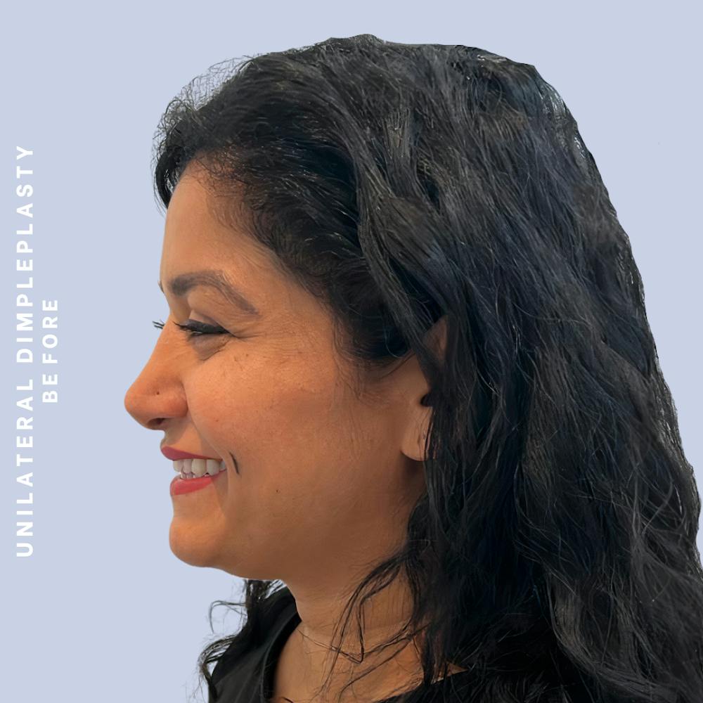 Dimpleplasty Before & After Gallery - Patient 146645761 - Image 5