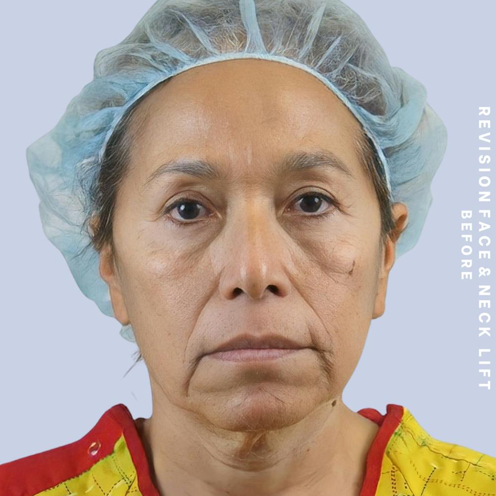 Face & Neck Before & After Gallery - Patient 145600105 - Image 1