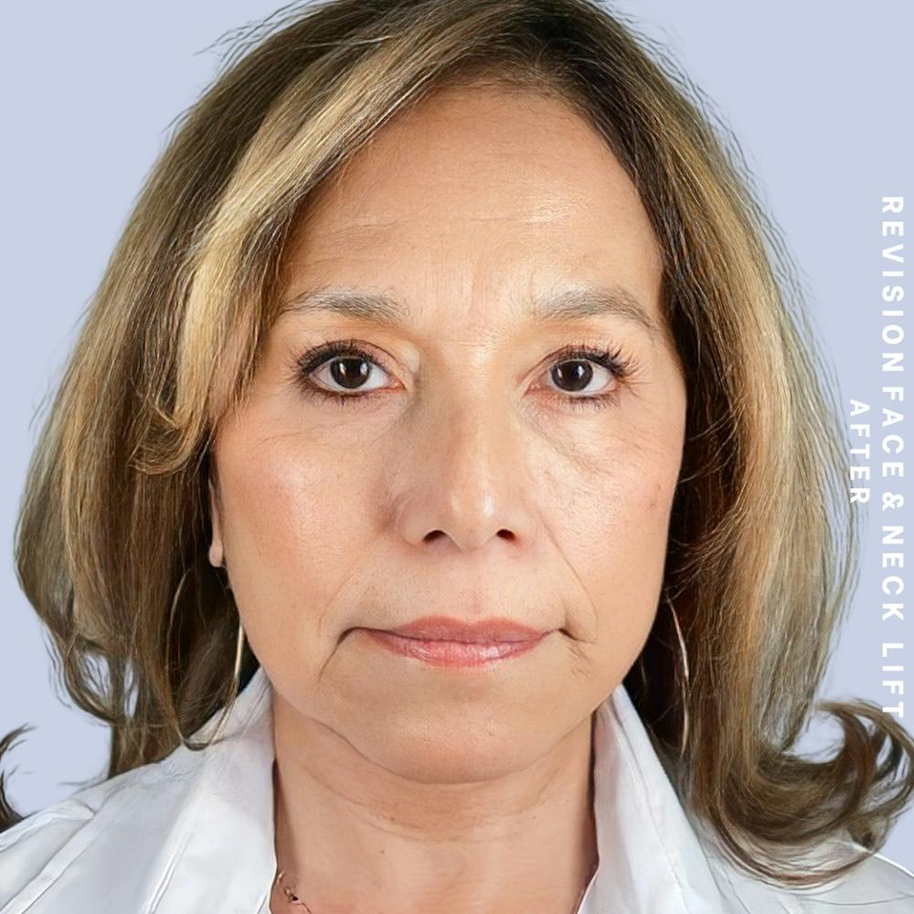 Face & Neck Before & After Gallery - Patient 145600105 - Image 2