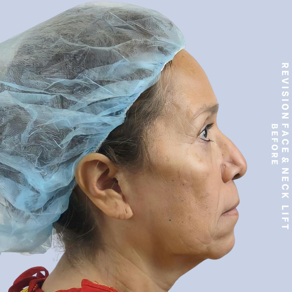 Face & Neck Before & After Gallery - Patient 145600105 - Image 3