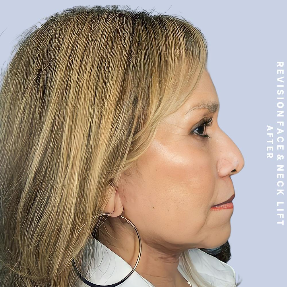 Face & Neck Before & After Gallery - Patient 145600105 - Image 4