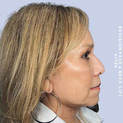 Face & Neck Before & After Gallery - Patient 145600105 - Image 4