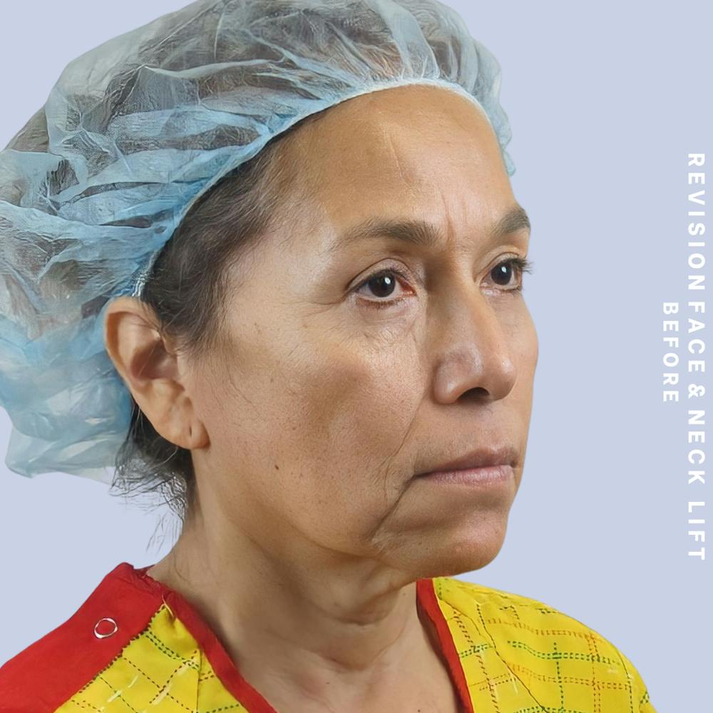 Face & Neck Before & After Gallery - Patient 145600105 - Image 5