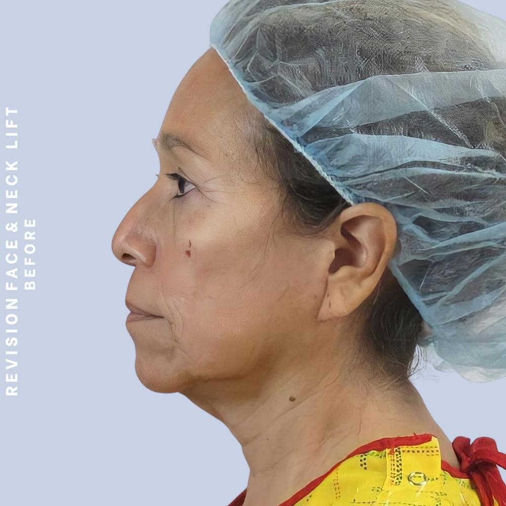 Face & Neck Before & After Gallery - Patient 145600105 - Image 7