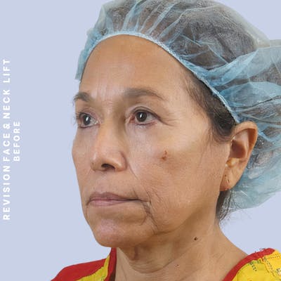 Face & Neck Before & After Gallery - Patient 145600105 - Image 10