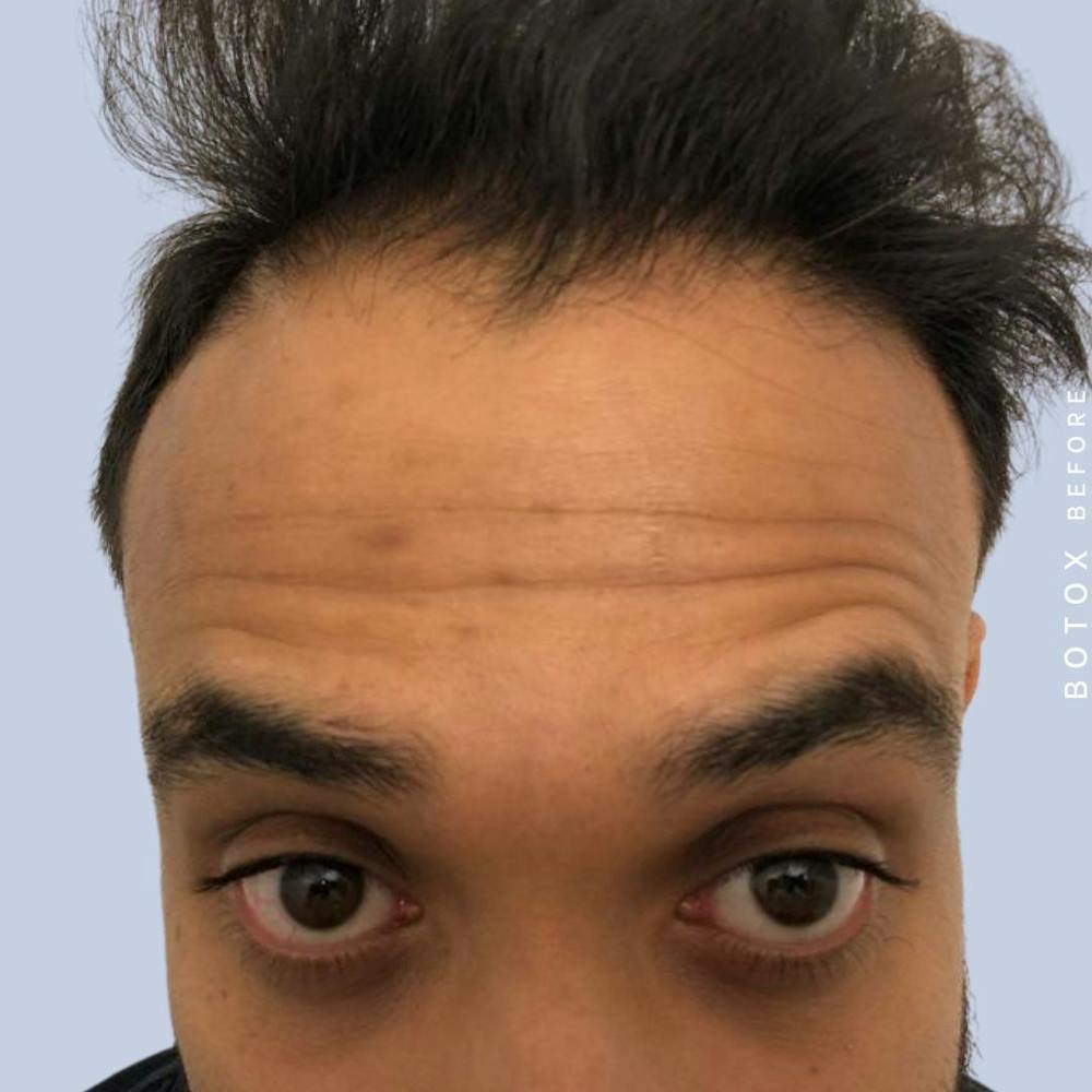 Wrinkles Before & After Gallery - Patient 146925034 - Image 1