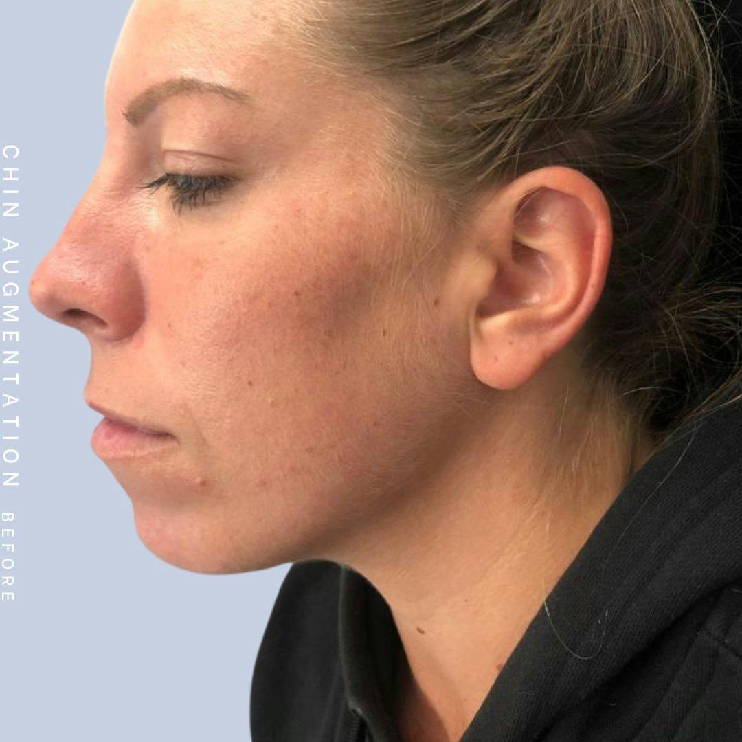 Mouth Before & After Gallery - Patient 146925211 - Image 5