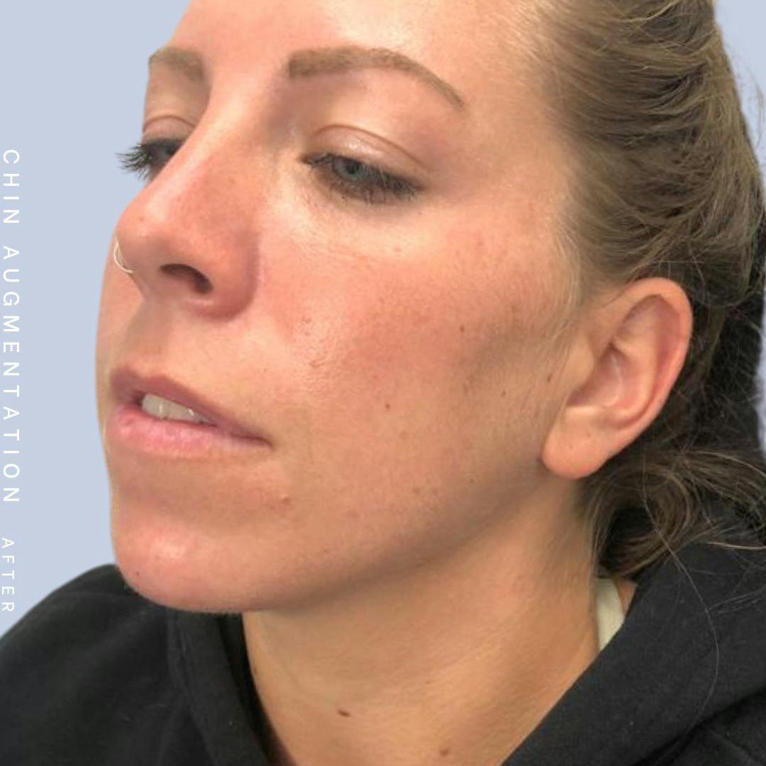 Mouth Before & After Gallery - Patient 146925211 - Image 4