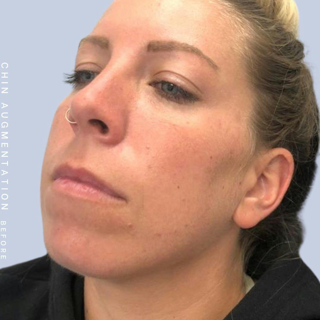 Mouth Before & After Gallery - Patient 146925211 - Image 3