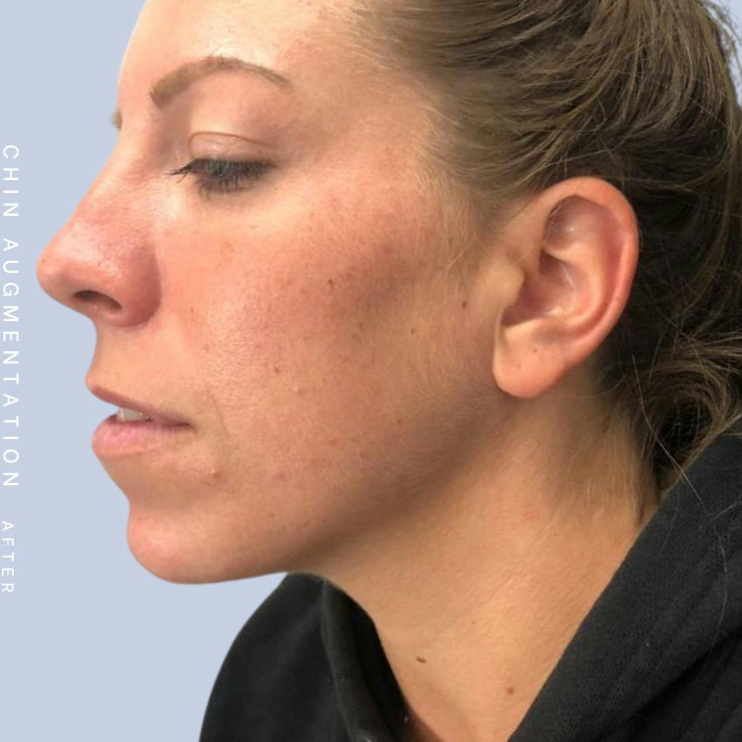 Mouth Before & After Gallery - Patient 146925211 - Image 6