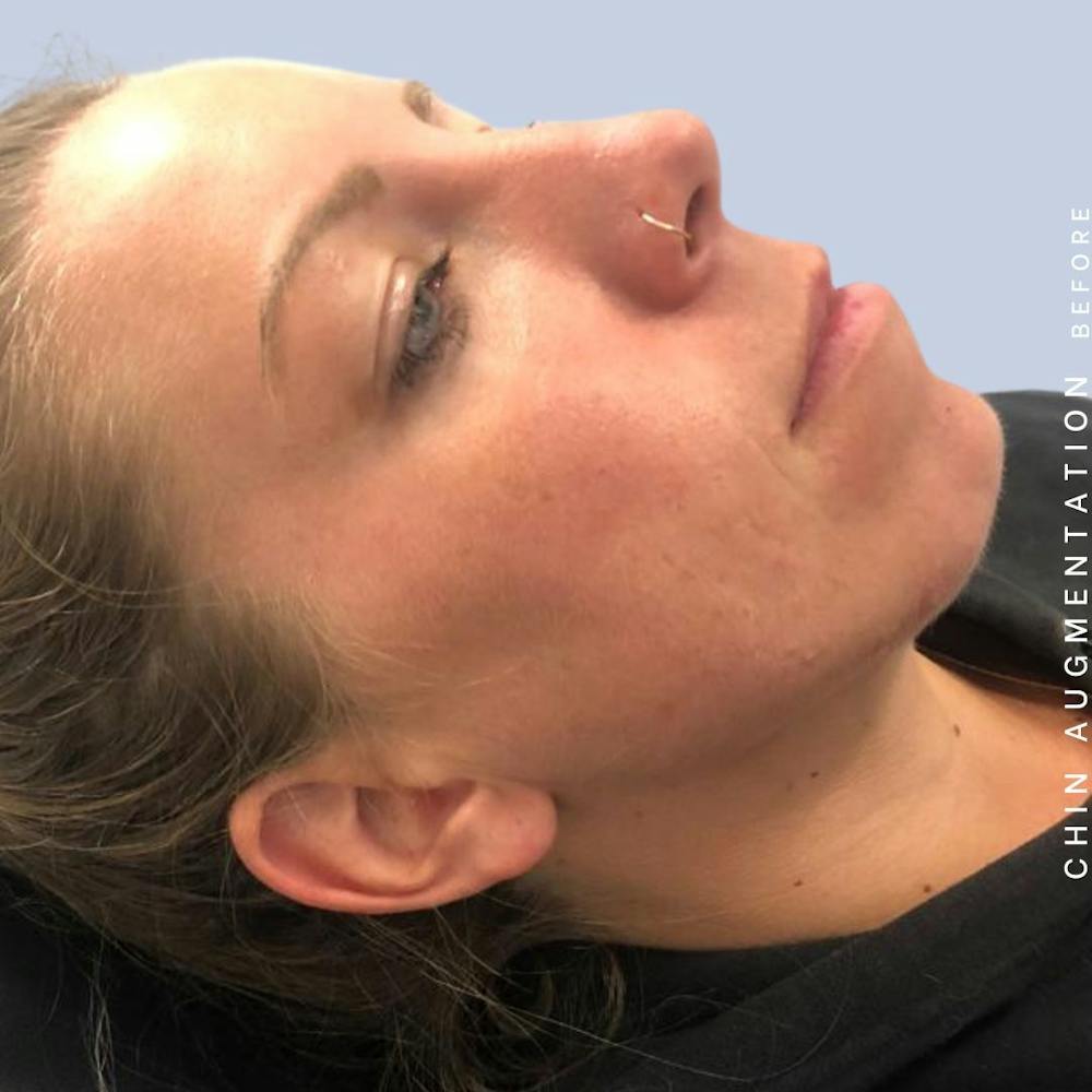 Mouth Before & After Gallery - Patient 146925211 - Image 1