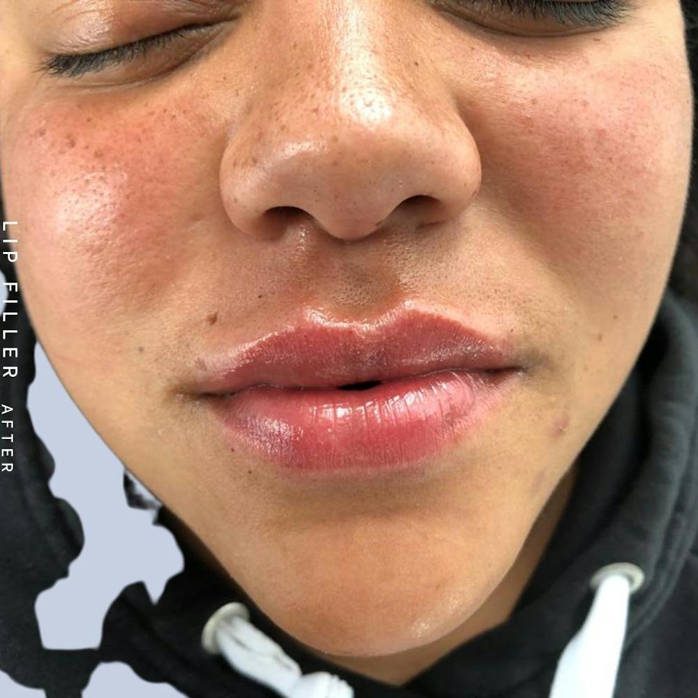 Non-Surgical Lips Before & After Gallery - Patient 108744410 - Image 4