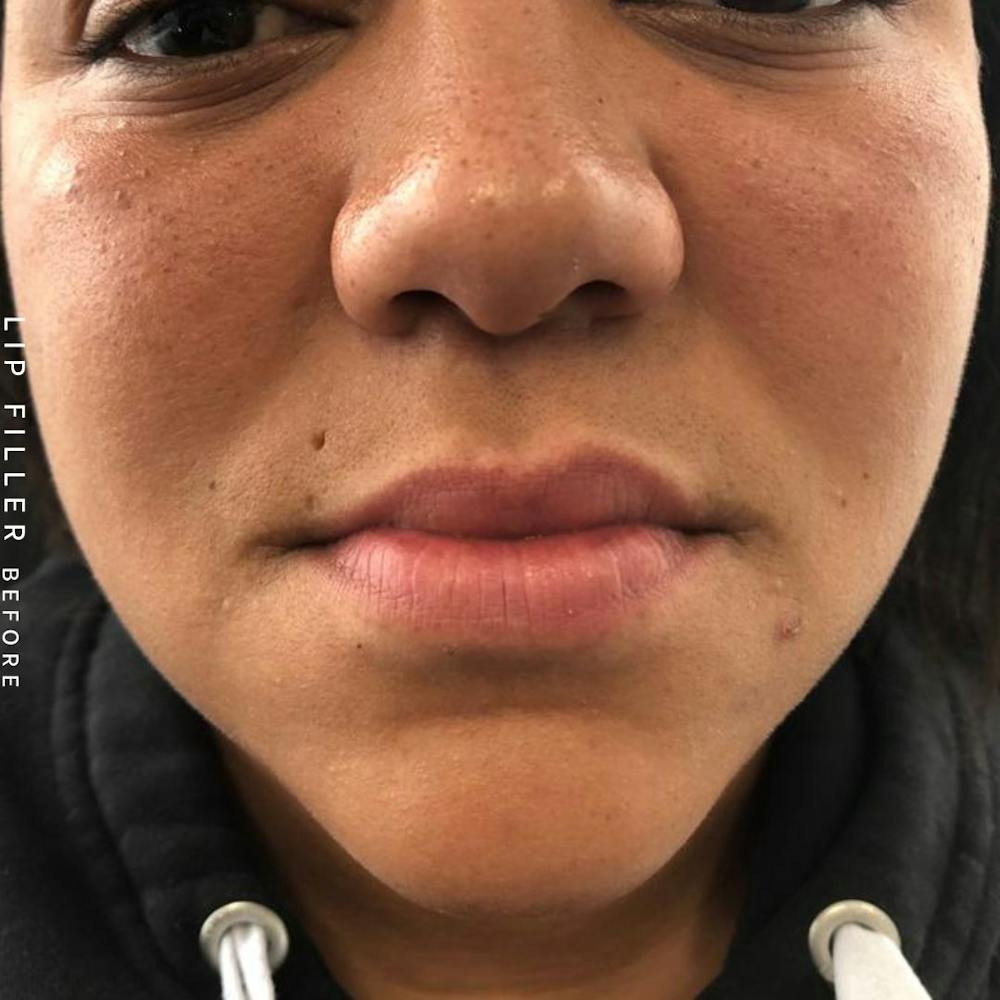 Non-Surgical Lips Before & After Gallery - Patient 108744410 - Image 3