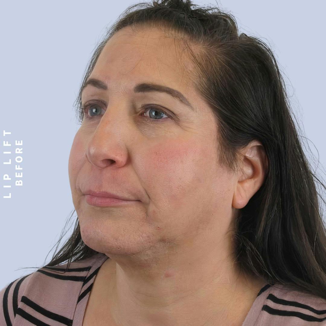 Lips Before & After Gallery - Patient 146925395 - Image 3