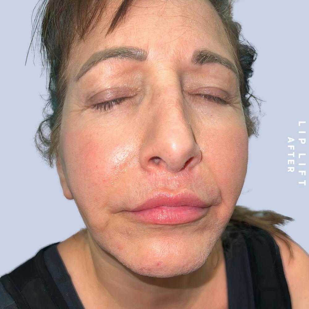 Lips Before & After Gallery - Patient 146925395 - Image 6