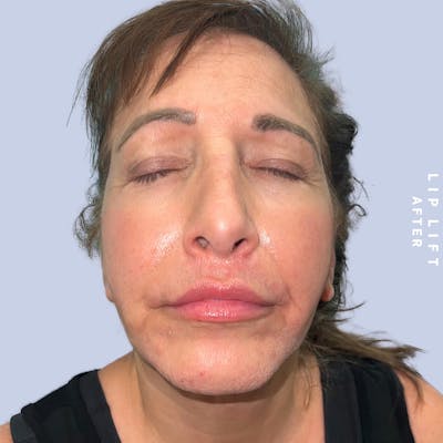 Lips Before & After Gallery - Patient 146925395 - Image 2