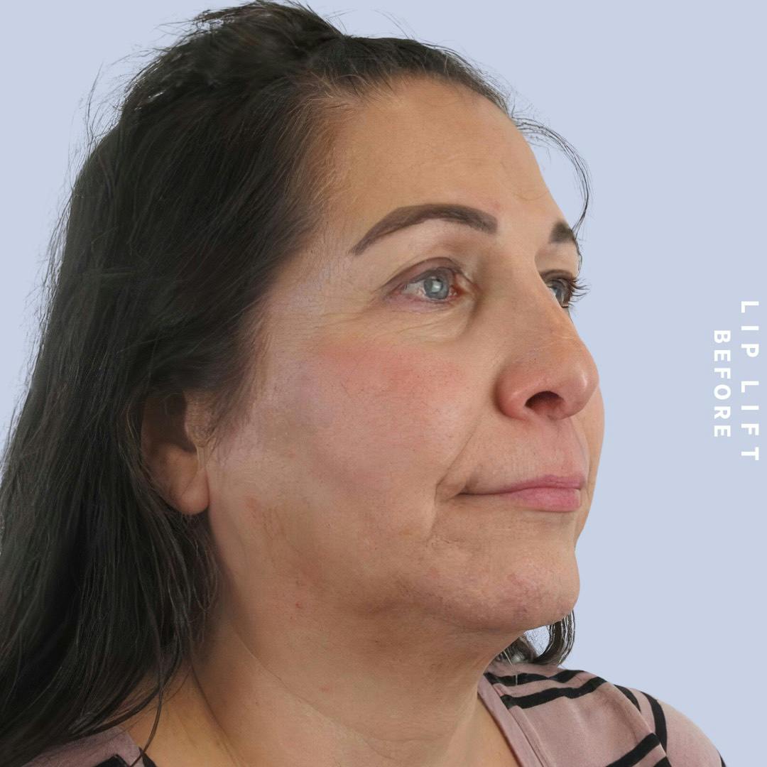 Lips Before & After Gallery - Patient 146925395 - Image 5