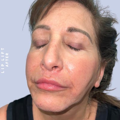 Lips Before & After Gallery - Patient 146925395 - Image 4