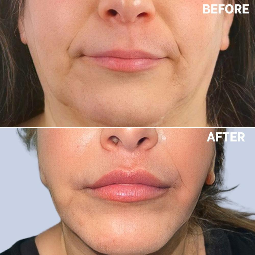 Lips Before & After Gallery - Patient 146925395 - Image 7