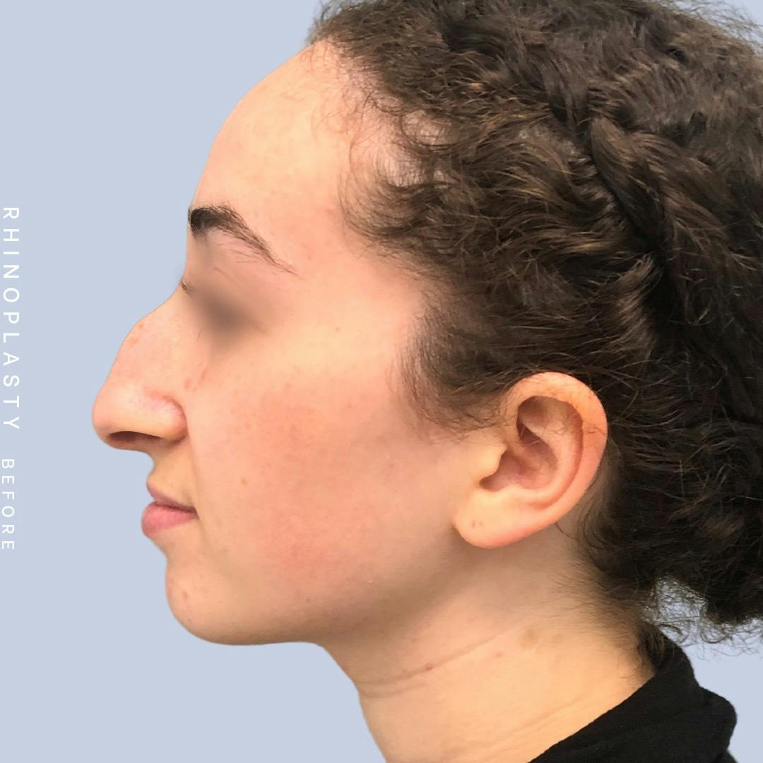 Nose Before & After Gallery - Patient 120868462 - Image 7