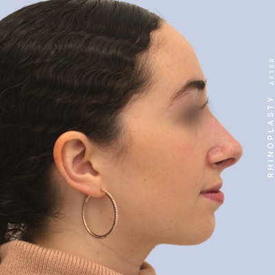 Nose Before & After Gallery - Patient 120868462 - Image 10