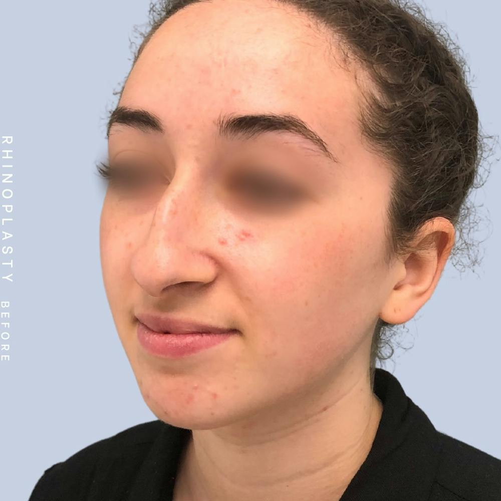 Nose Before & After Gallery - Patient 120868462 - Image 3