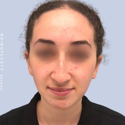 Nose Before & After Gallery - Patient 120868462 - Image 1
