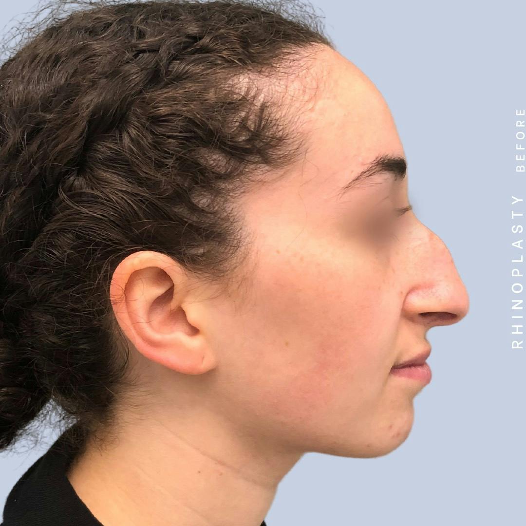 Nose Before & After Gallery - Patient 120868462 - Image 3
