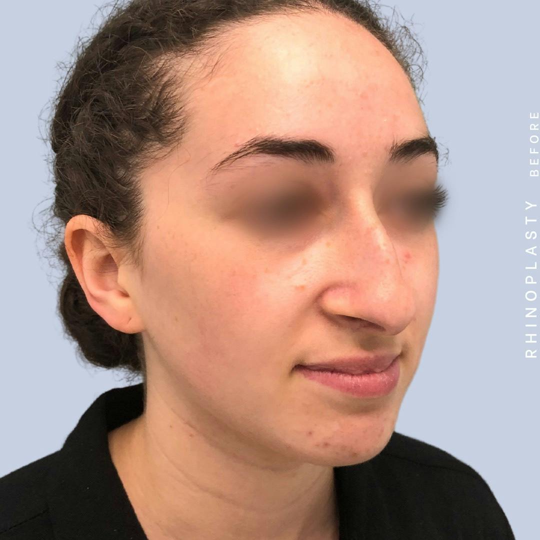 Nose Before & After Gallery - Patient 120868462 - Image 1