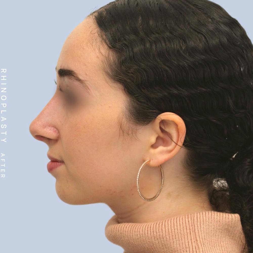 Nose Before & After Gallery - Patient 120868462 - Image 6