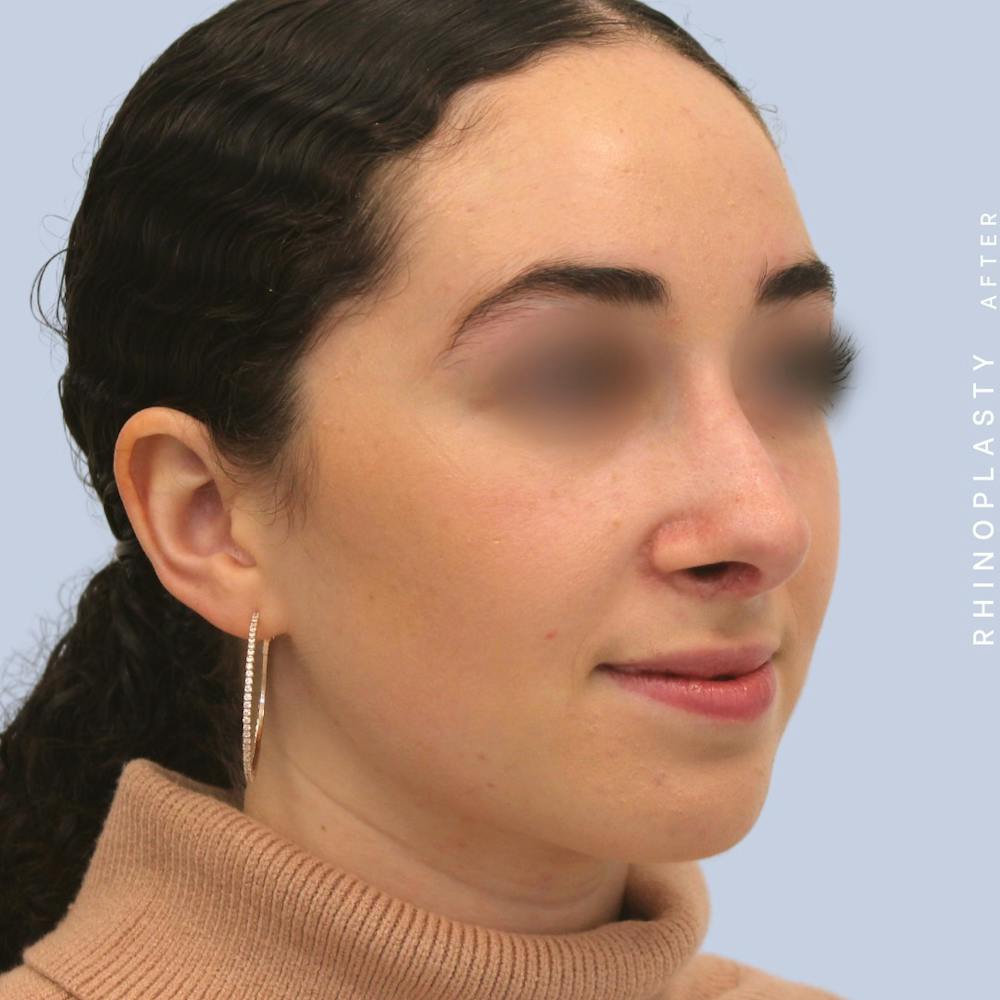 Nose Before & After Gallery - Patient 120868462 - Image 8