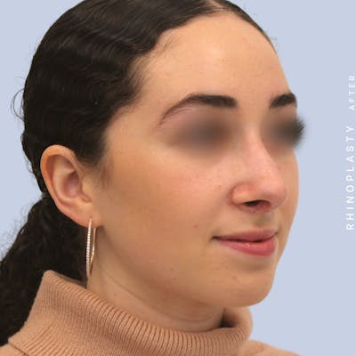 Nose Before & After Gallery - Patient 120868462 - Image 8