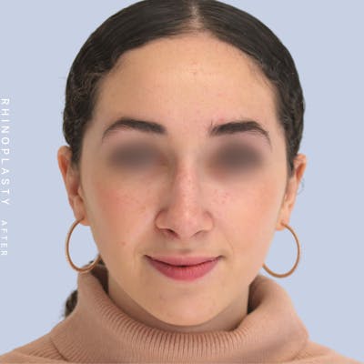 Nose Before & After Gallery - Patient 120868462 - Image 2