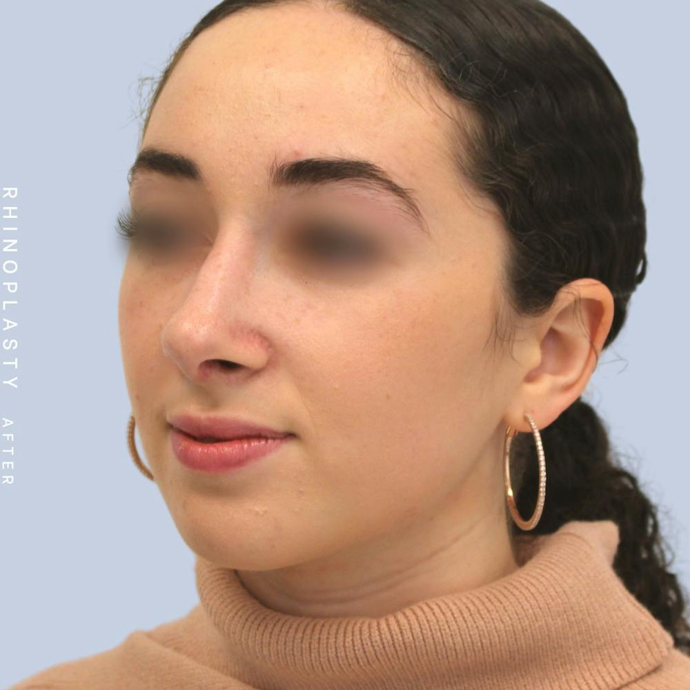 Nose Before & After Gallery - Patient 120868462 - Image 4
