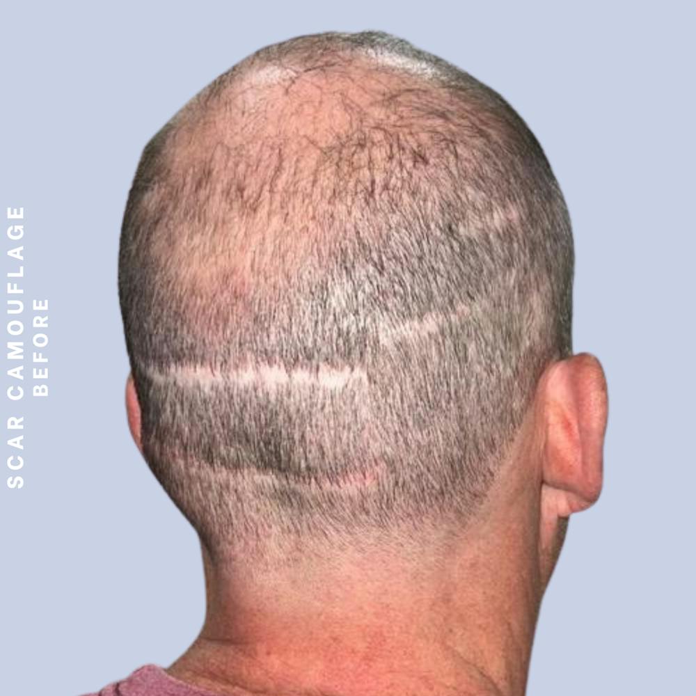 Hair Restoration Before & After Gallery - Patient 149148240 - Image 1