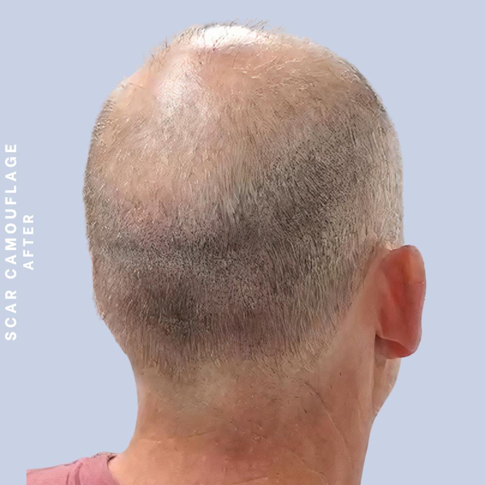 Hair Restoration Before & After Gallery - Patient 149148240 - Image 2