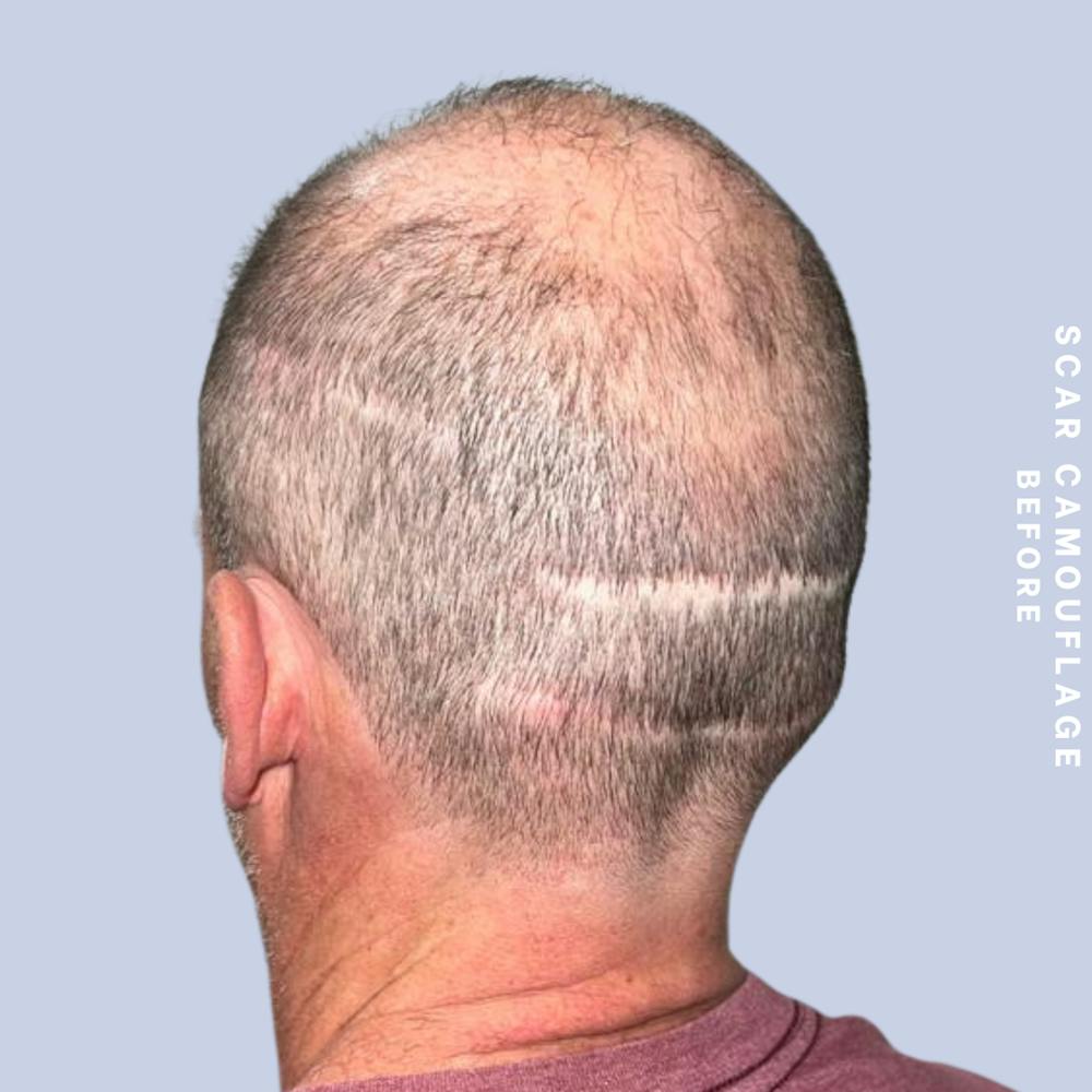 Hair Restoration Before & After Gallery - Patient 149148240 - Image 3