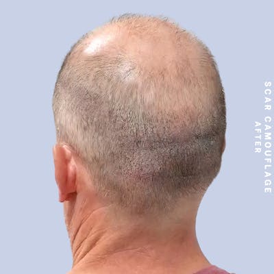 Hair Restoration Before & After Gallery - Patient 149148240 - Image 4
