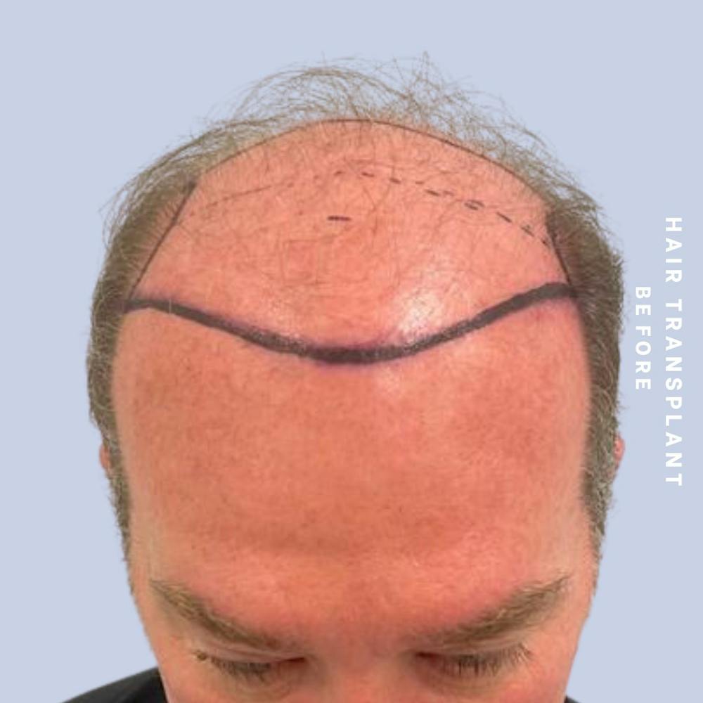 Men's Hair Before & After Gallery - Patient 149960092 - Image 1