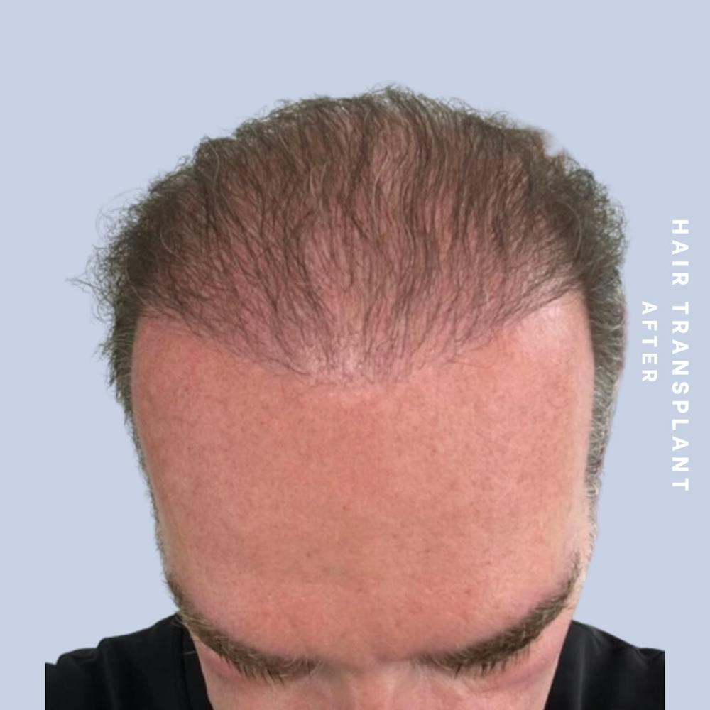 Hair Before & After Gallery - Patient 149960092 - Image 2