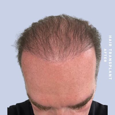 Men's Hair Before & After Gallery - Patient 149960092 - Image 2