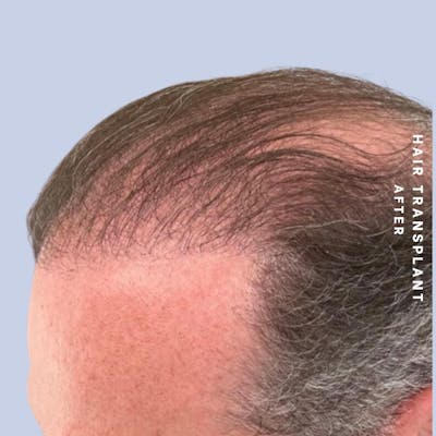Men's Hair Before & After Gallery - Patient 149960092 - Image 4