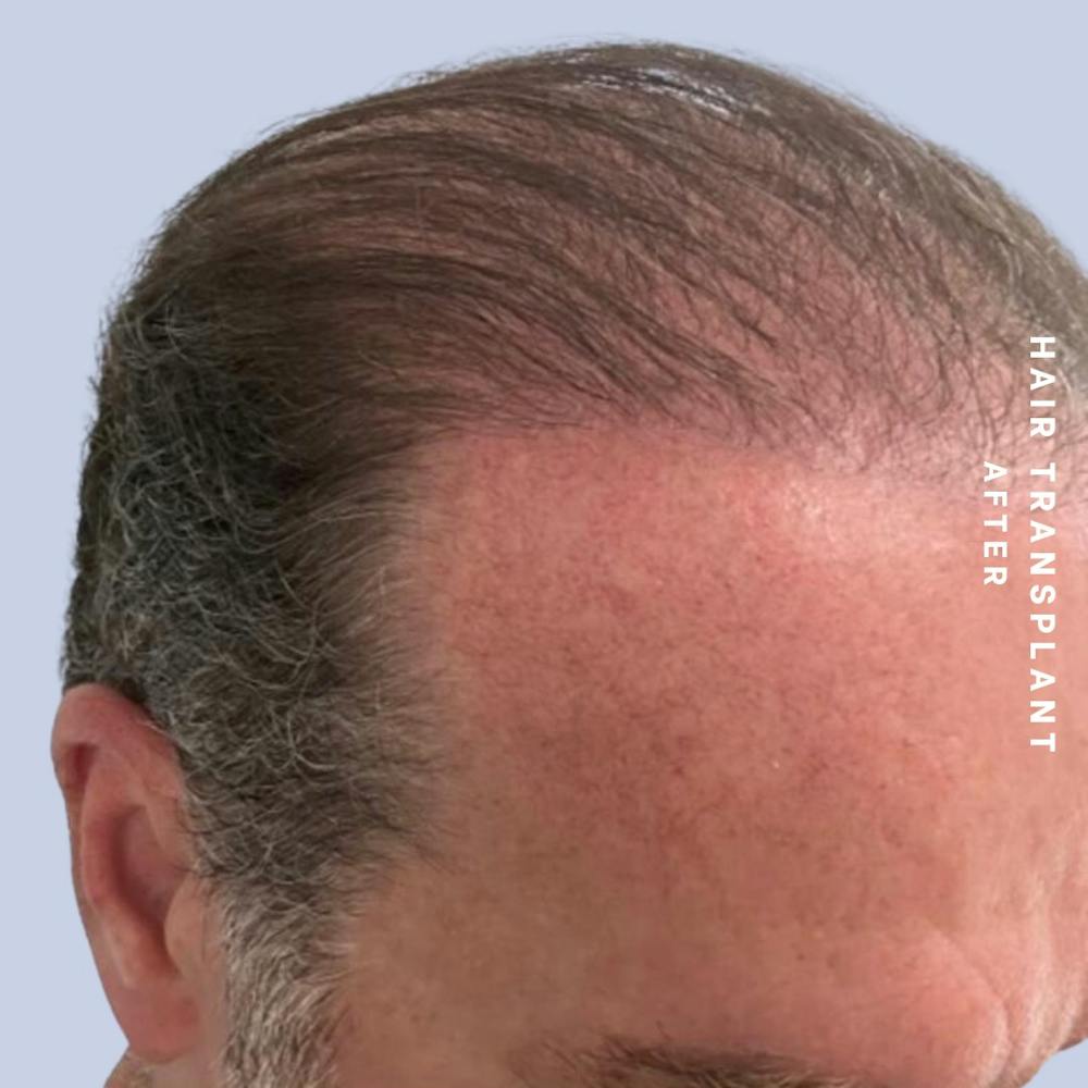 Men's Hair Before & After Gallery - Patient 149960092 - Image 6