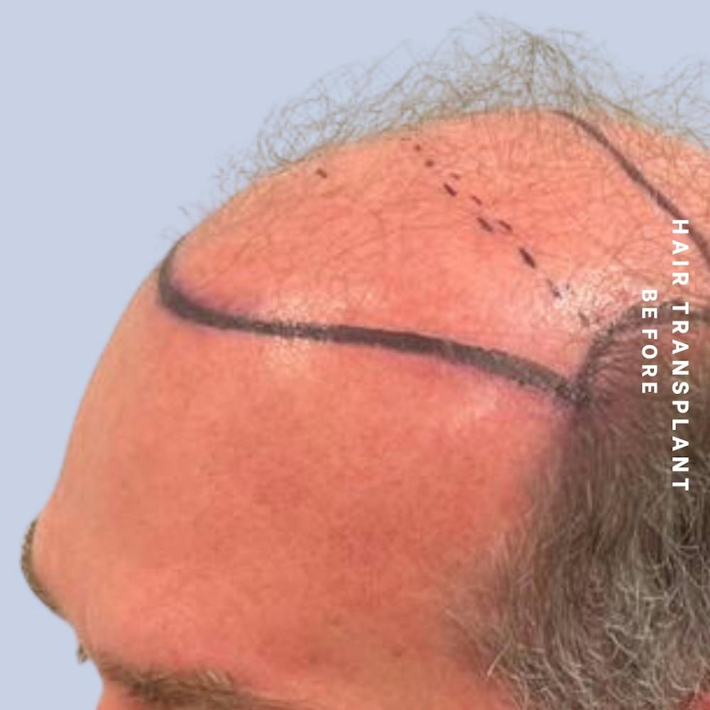 Men's Hair Before & After Gallery - Patient 149960092 - Image 3