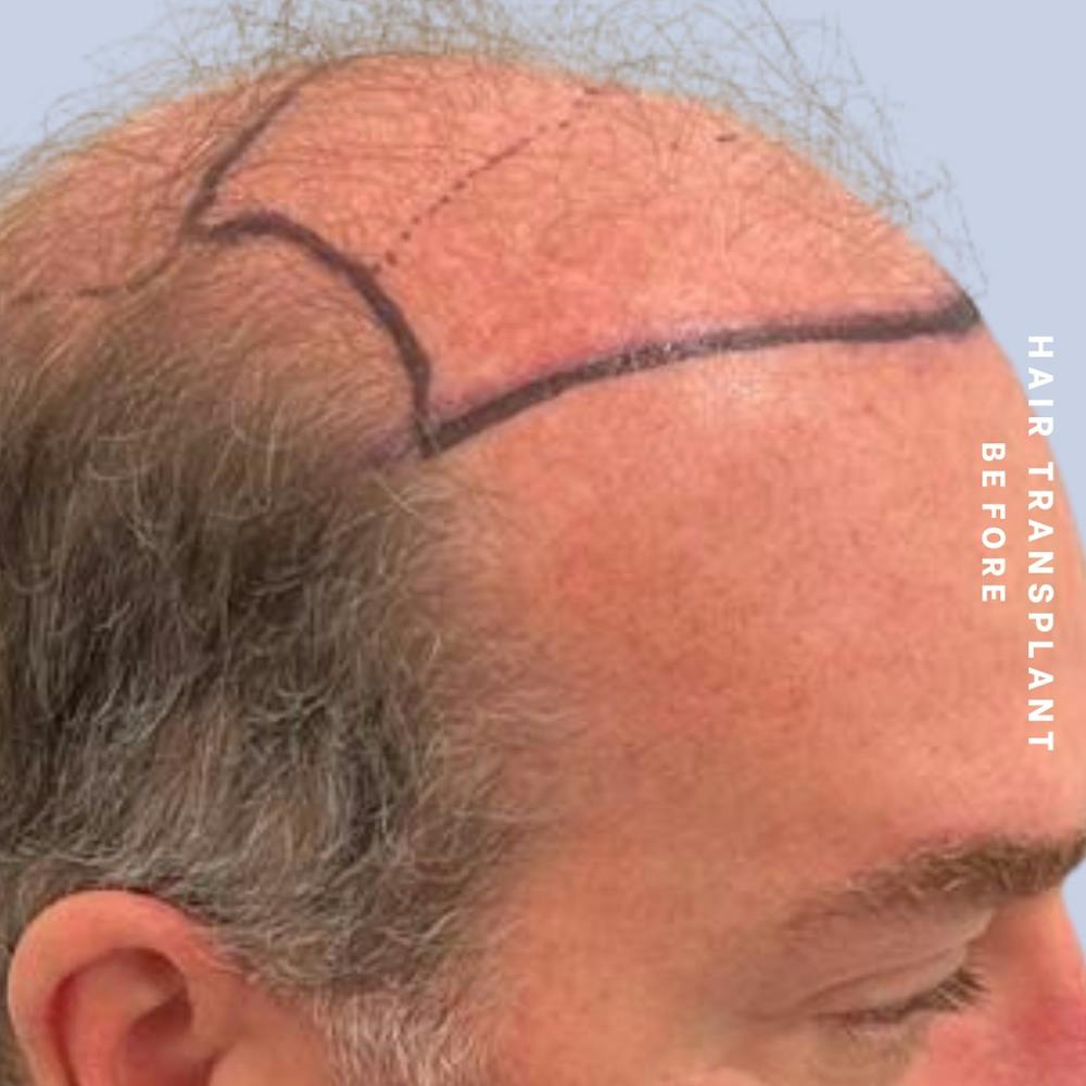Men's Hair Before & After Gallery - Patient 149960092 - Image 5