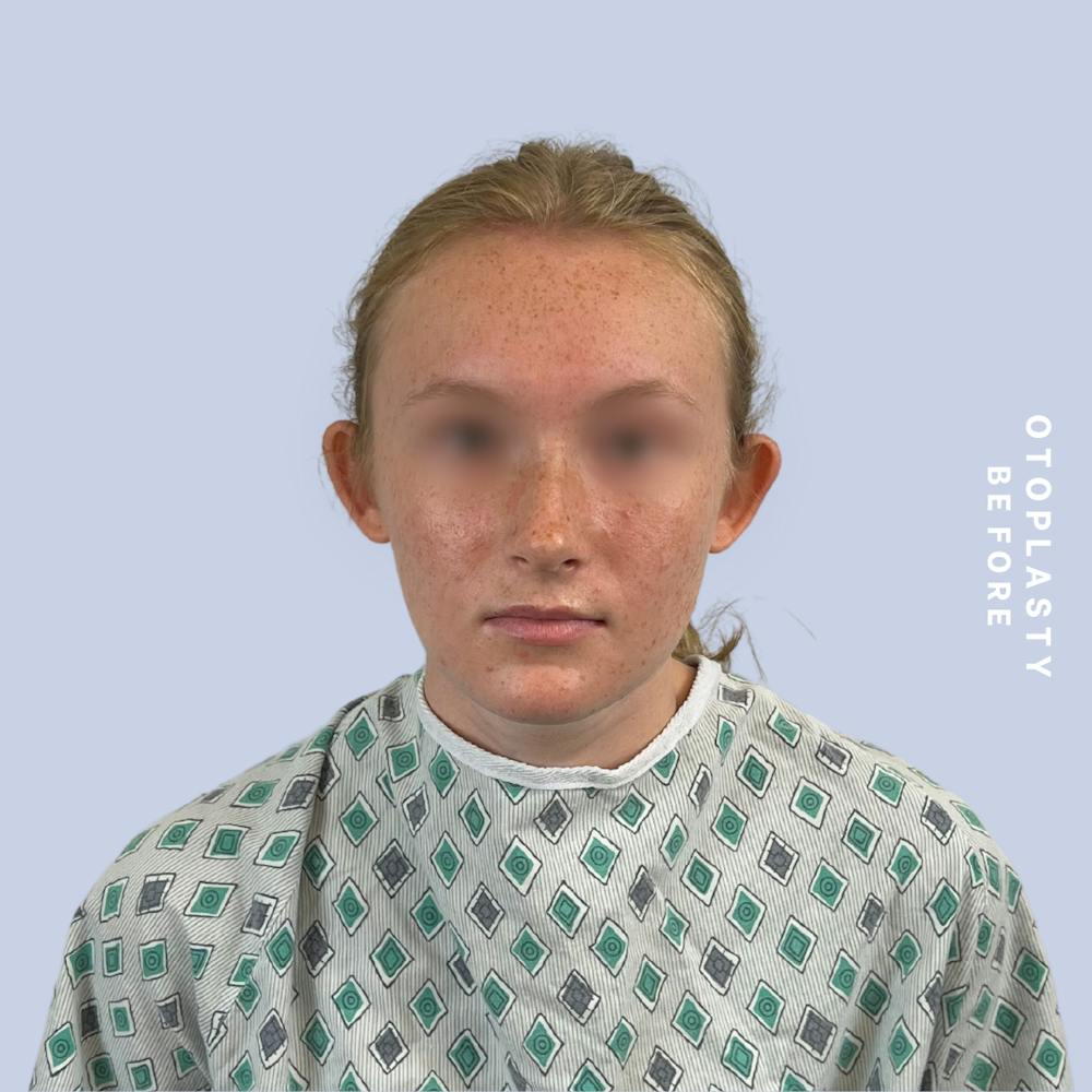 Ears Before & After Gallery - Patient 155009071 - Image 1