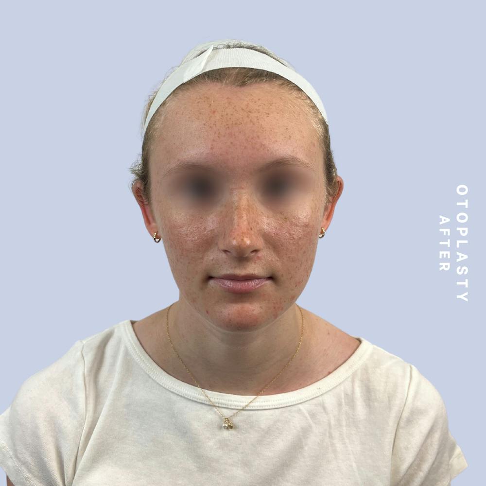 Ears Before & After Gallery - Patient 155009071 - Image 2