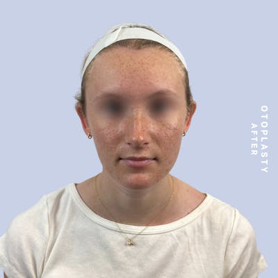 Ears Before & After Gallery - Patient 155009071 - Image 2