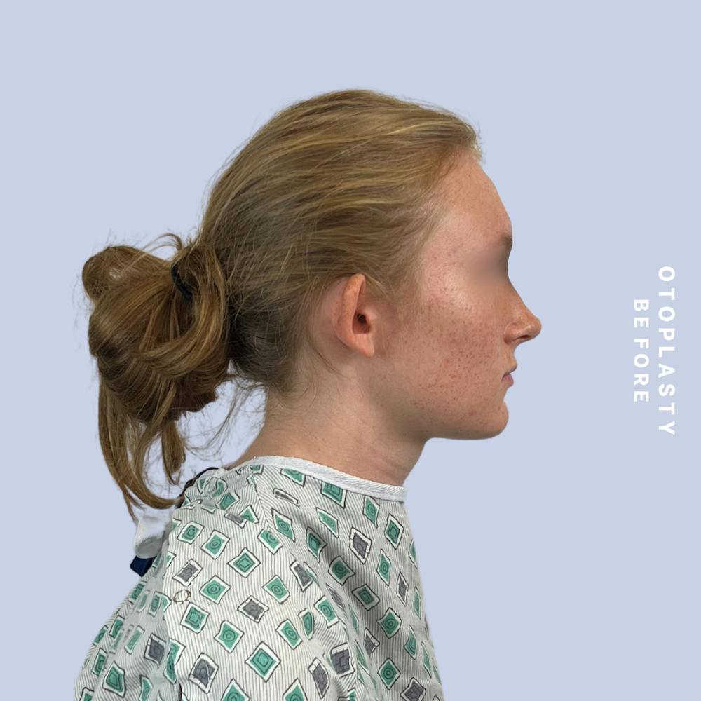 Ears Before & After Gallery - Patient 155009071 - Image 3