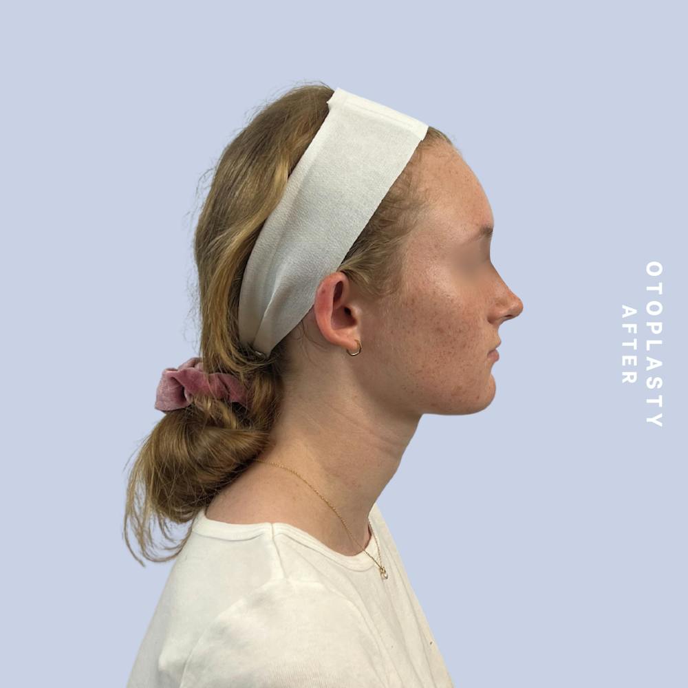 Ears Before & After Gallery - Patient 155009071 - Image 4